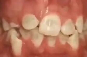 Как меняются зубы после установки брекетов? 41
